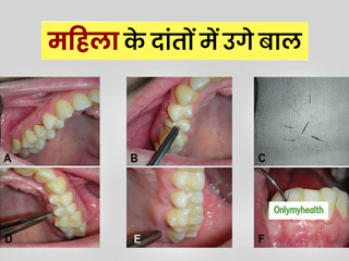 19 साल की लड़की के मसूड़ों में उगे बालों को डॉक्टरों ने सर्जरी से निकाला, 60 साल में छठा मामला 
